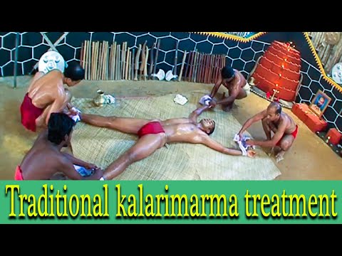 Traditional Marma Chikilsa Uzhichil & Treatments while dislocation of joints (Duration: 01:43:00)